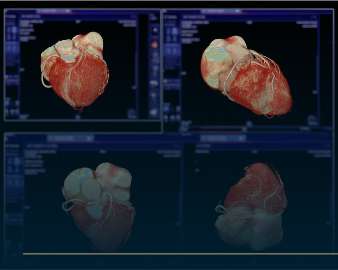 Medical imaging of a heart in four perspectives, showing detailed views of the organ with visible arteries and veins. The images highlight the hearts structure against a dark background, with faint medical interface elements visible.